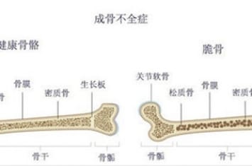 瓷娃娃病是怎么回事