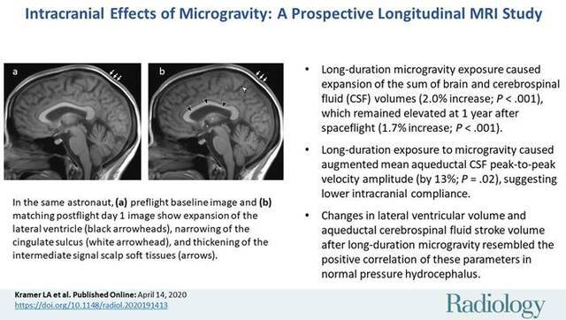 《放射学》杂志：宇航员在国际空间站停留后大脑的白质发生明显变化