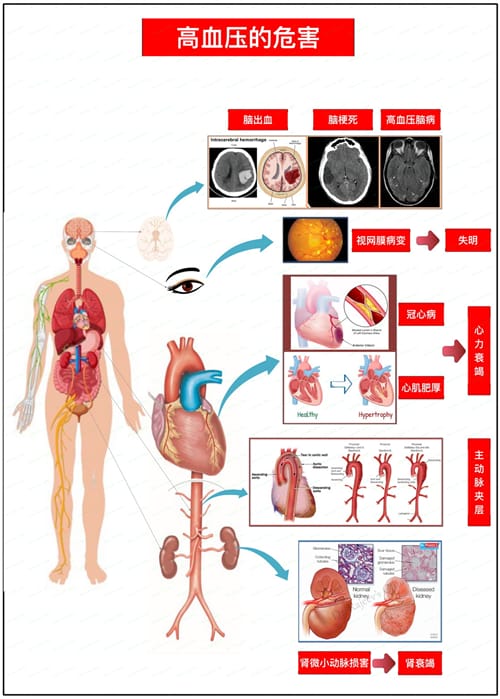 高血压会引起哪些疾病