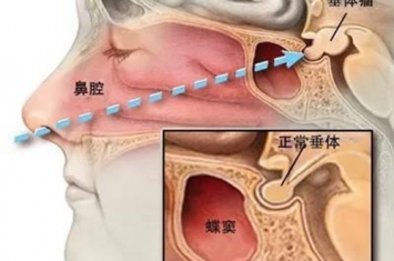 垂体瘤都有哪些症状