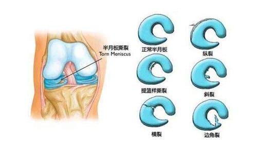 半月板撕裂怎么治疗