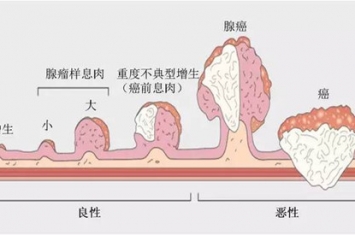 息肉是什么东西