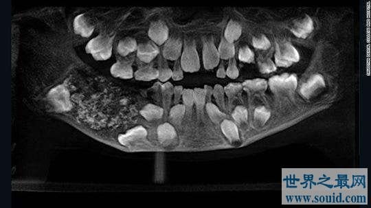​印度7岁男孩下颚肿胀,嘴里竟然多长了526颗牙齿