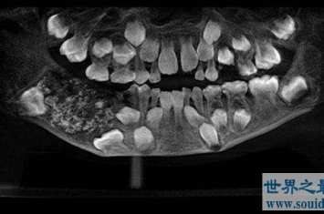 ​印度7岁男孩下颚肿胀,嘴里竟然多长了526颗牙齿